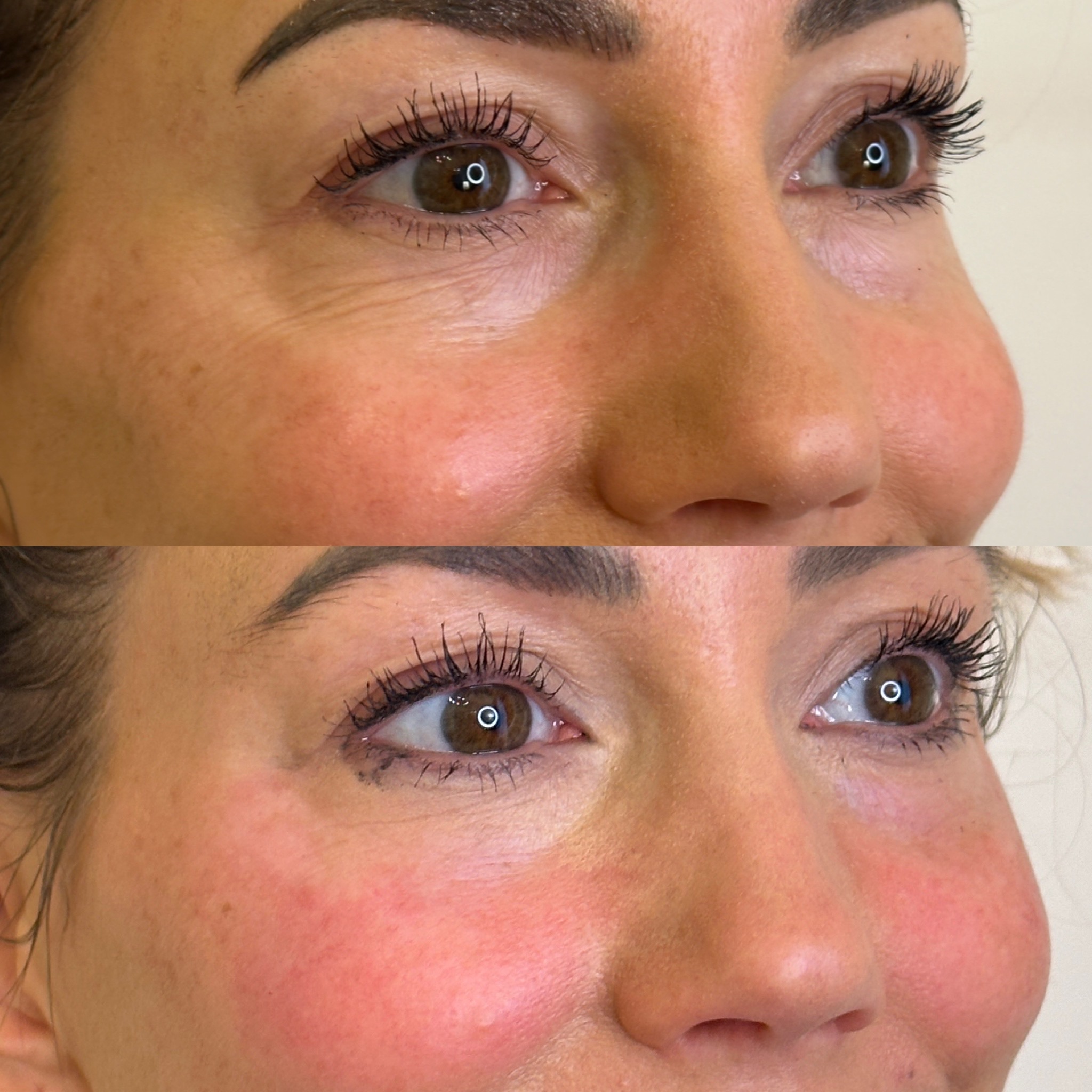 Facial Harmonisation 3