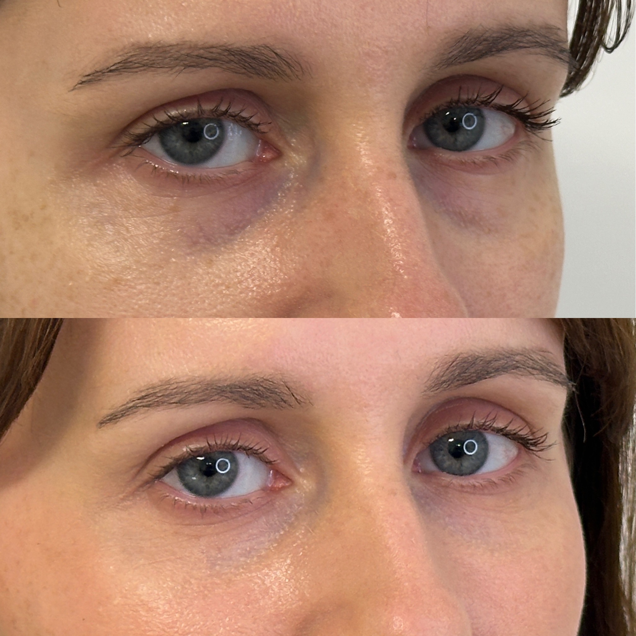 Facial Harmonisation 4