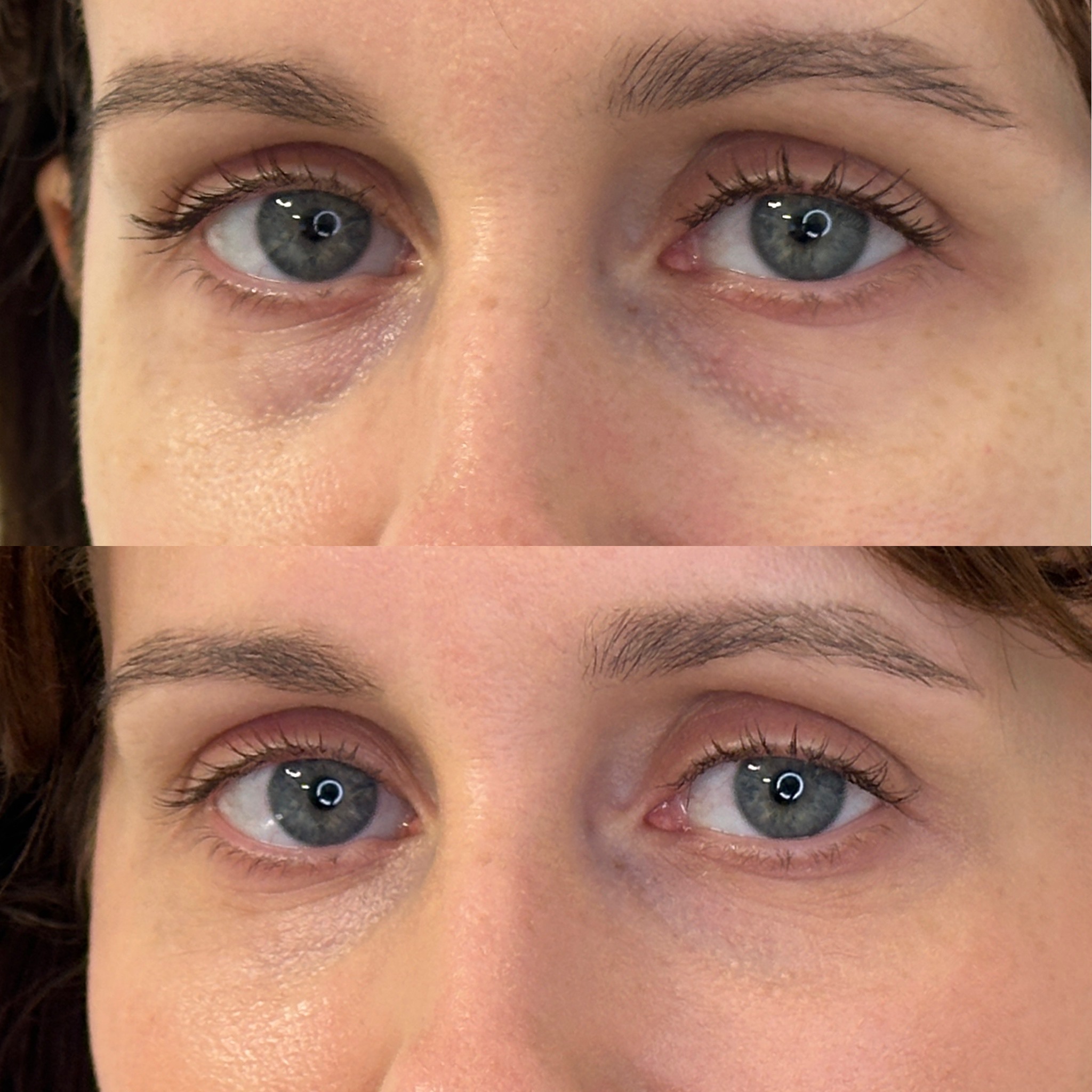 Facial Harmonisation 4
