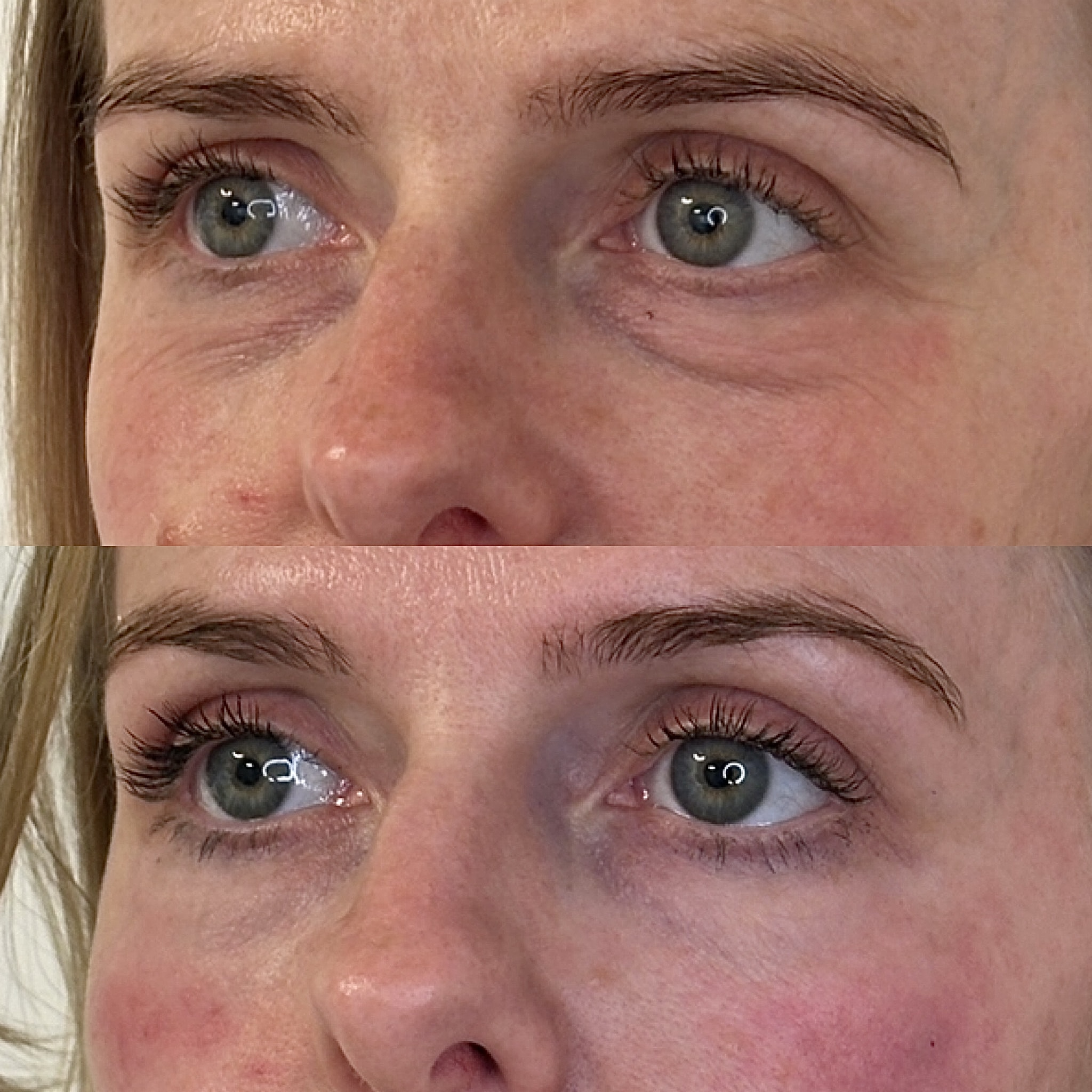 Facial Harmonisation 4