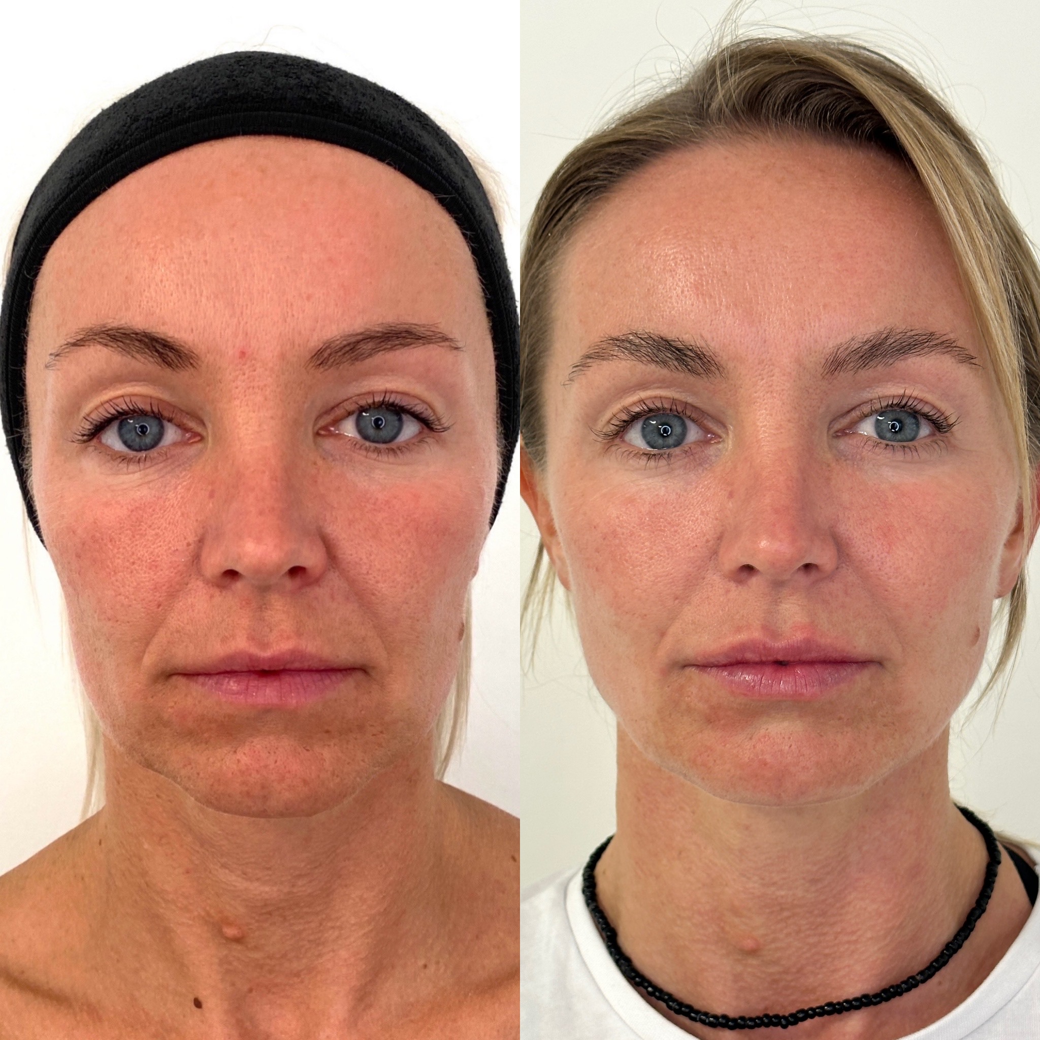 Facial Harmonisation 1