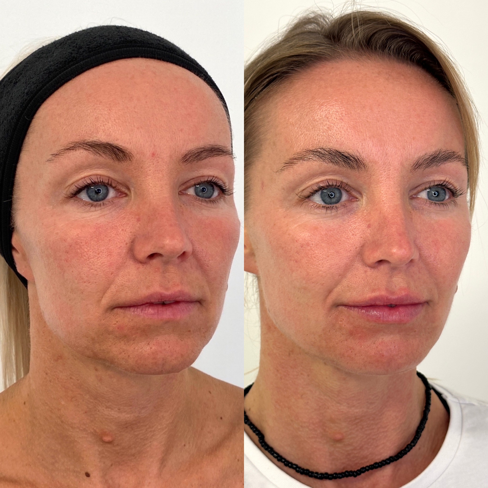 Facial Harmonisation 2
