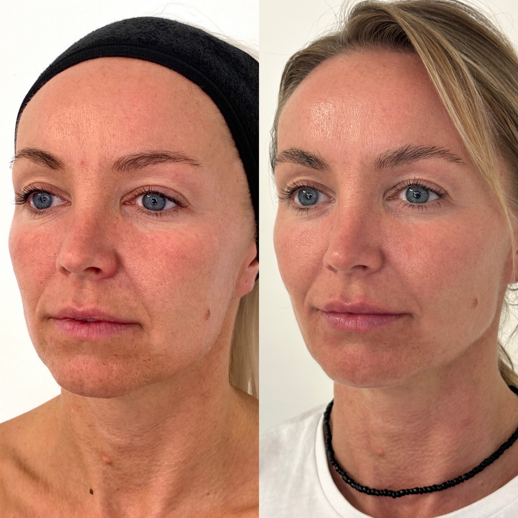Facial Harmonisation 3