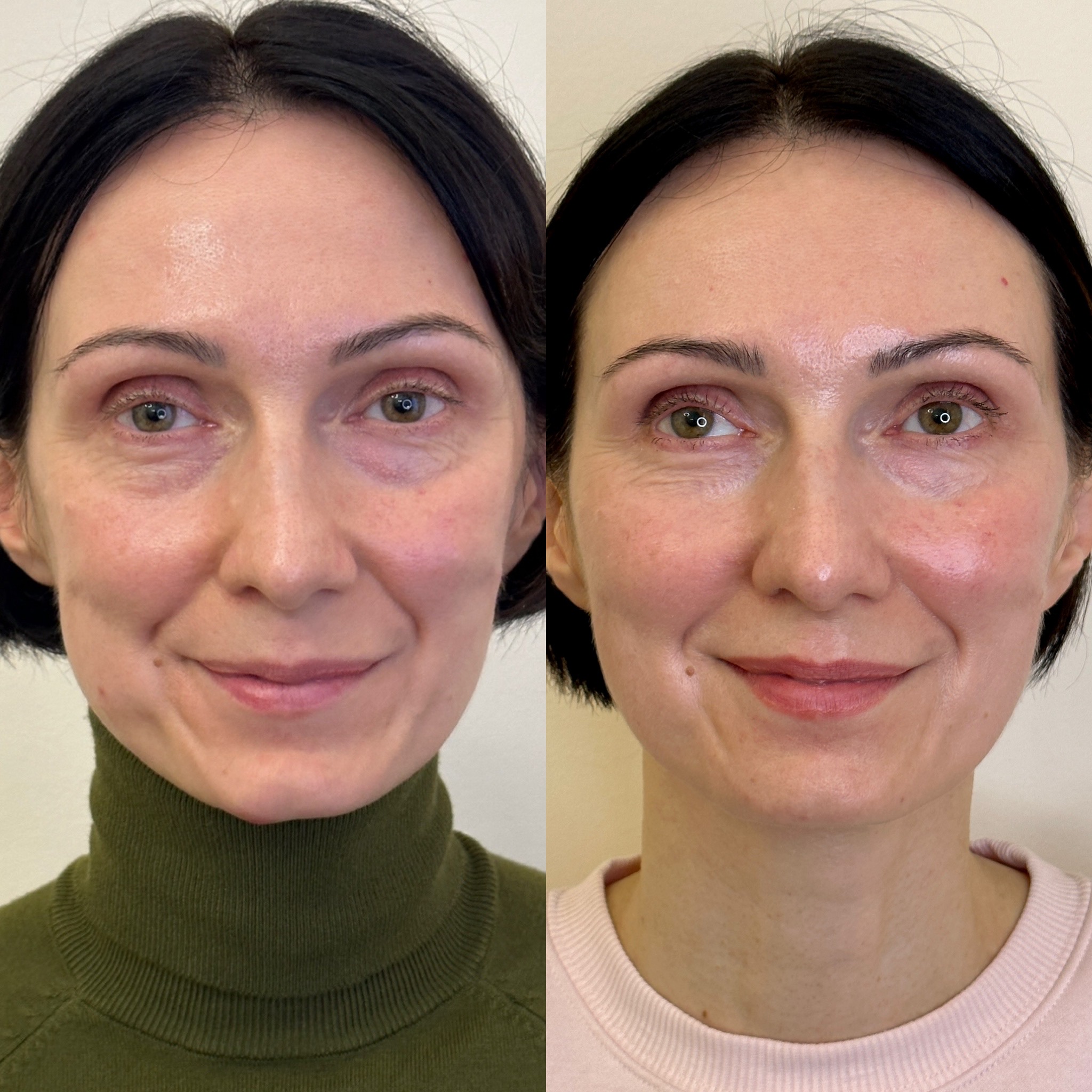 Facial Harmonisation 4