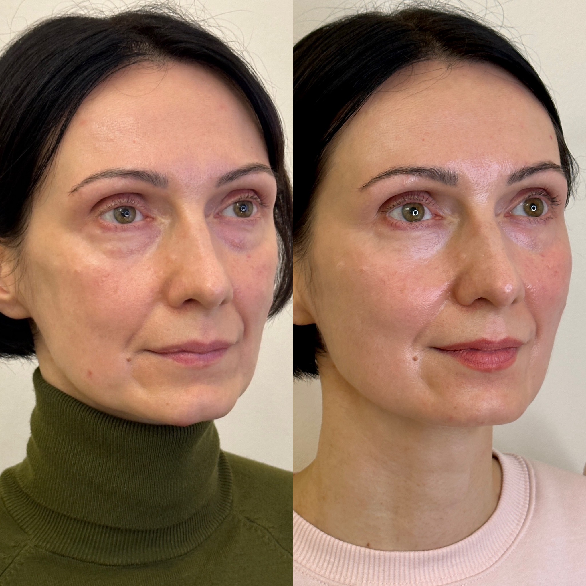 Facial Harmonisation 4