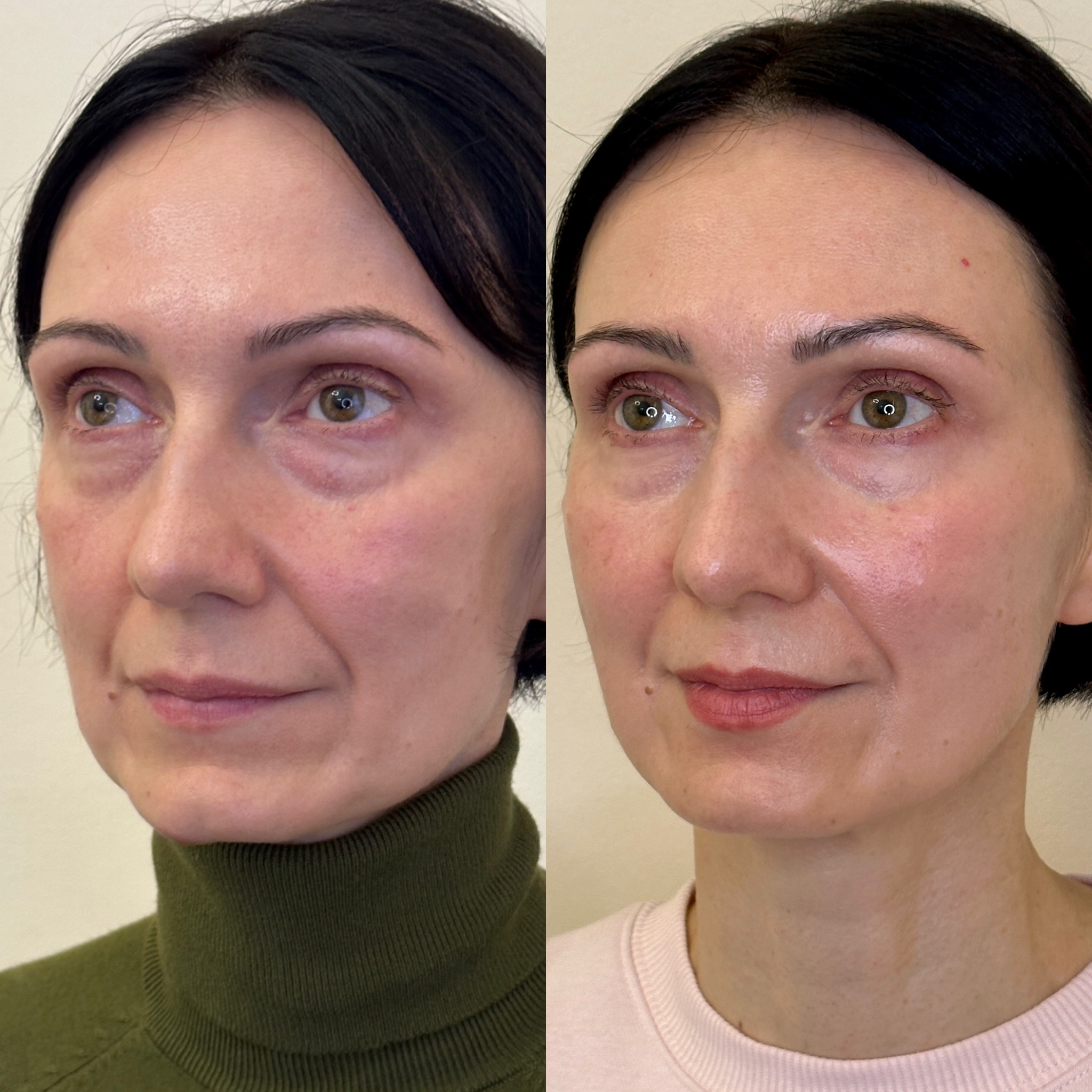 Facial Harmonisation 4