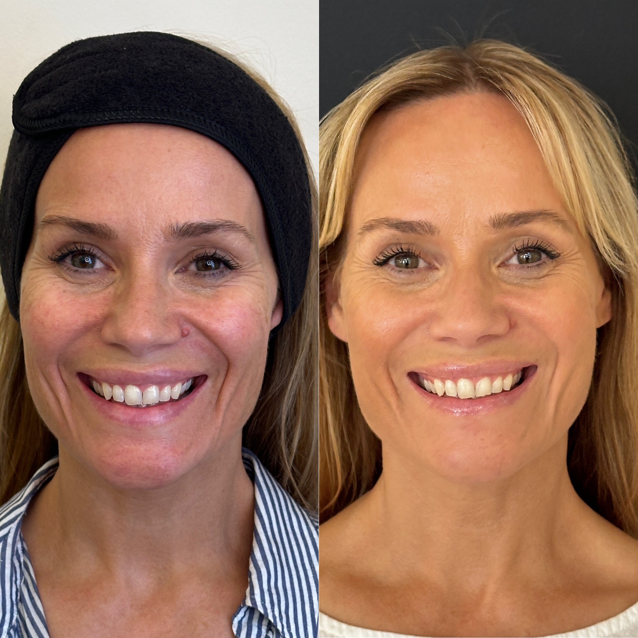 Facial Harmonisation 4