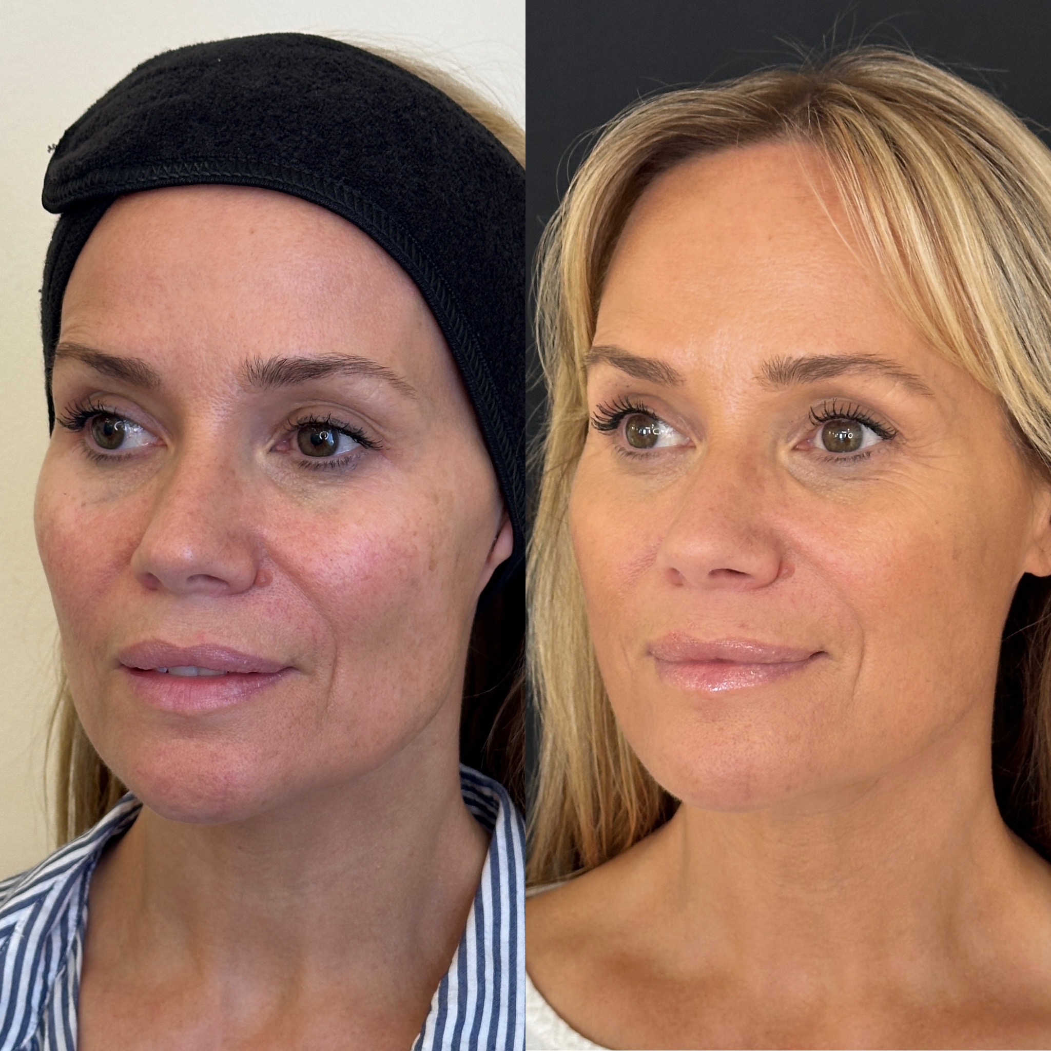 Facial Harmonisation 4