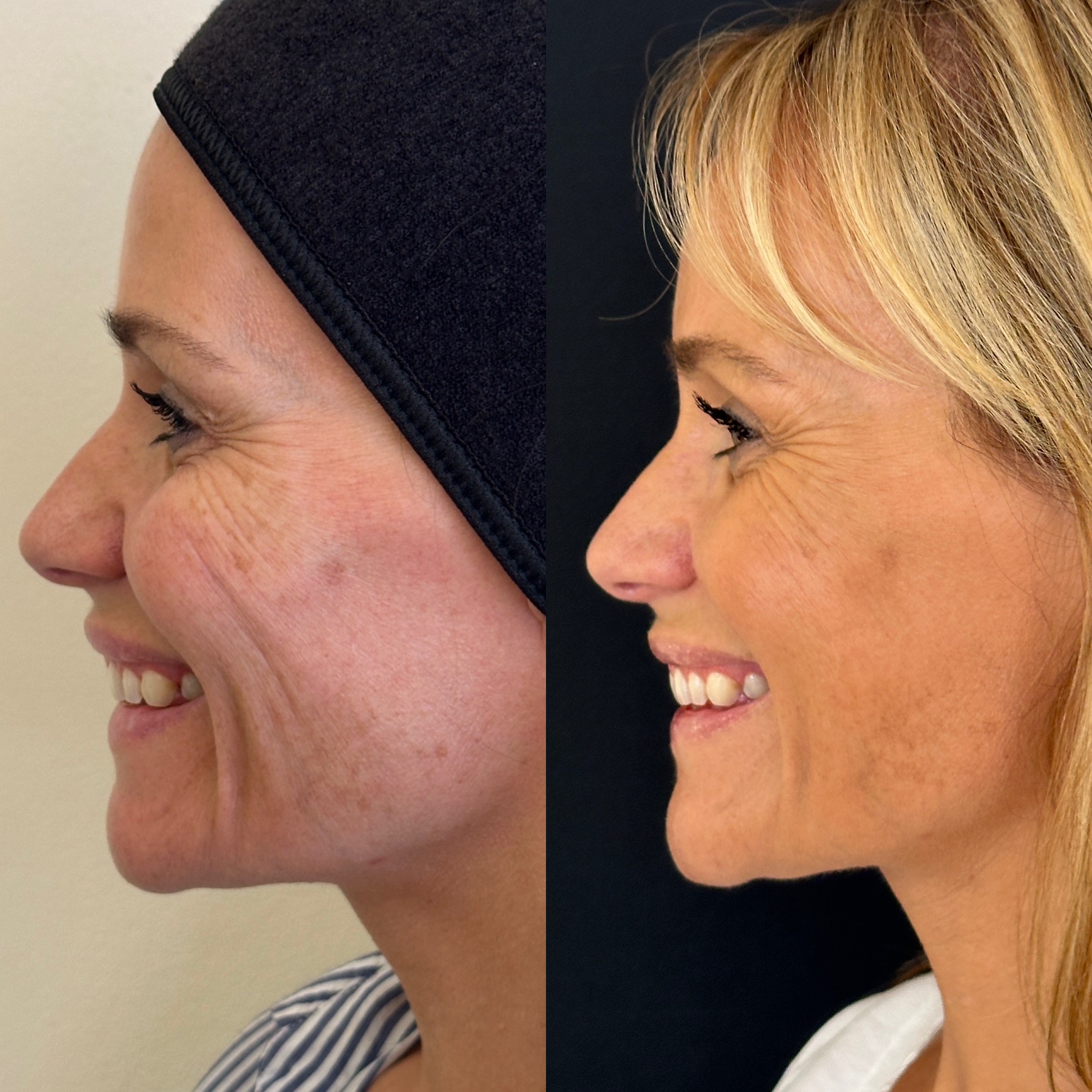 Facial Harmonisation 4