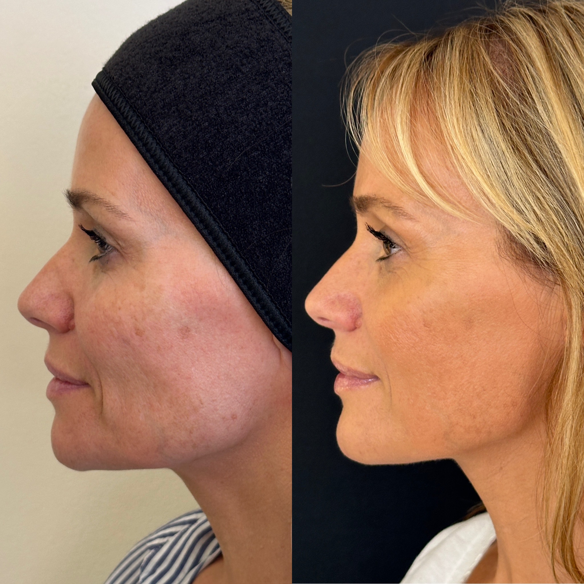 Facial Harmonisation 4