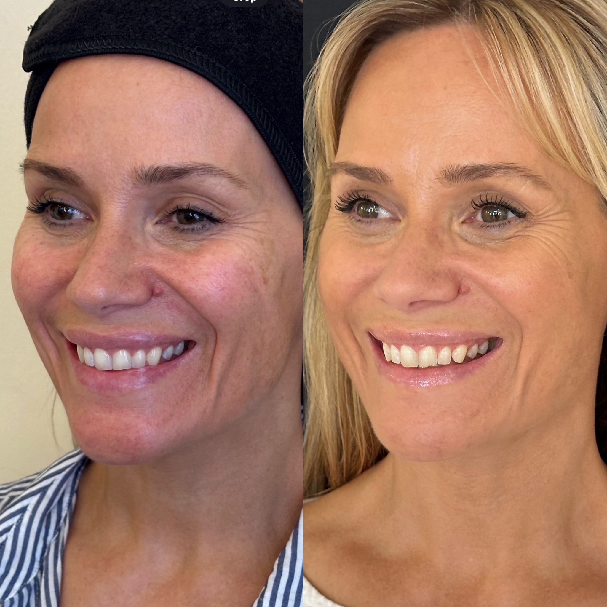 Facial Harmonisation 4