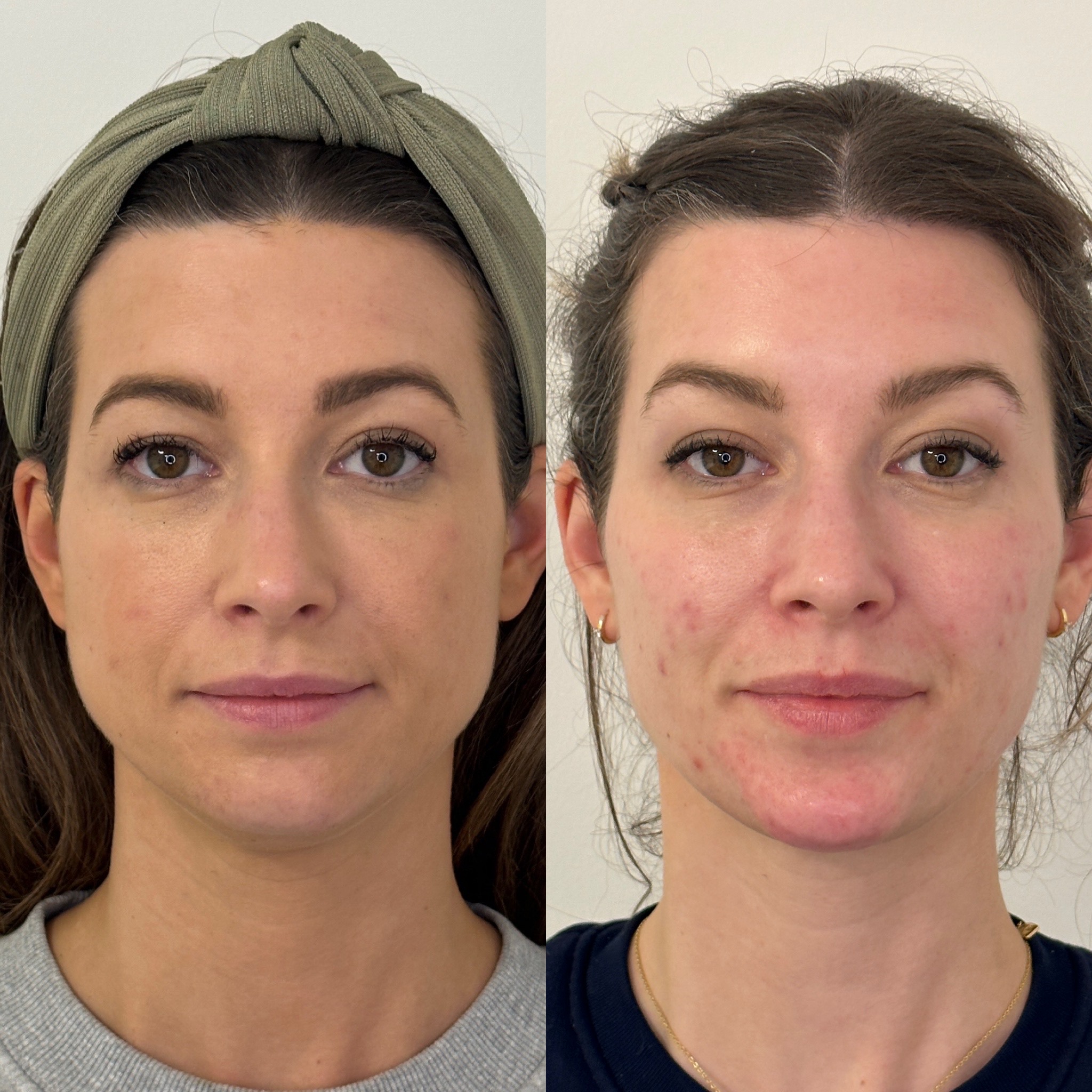 Facial Harmonisation 4