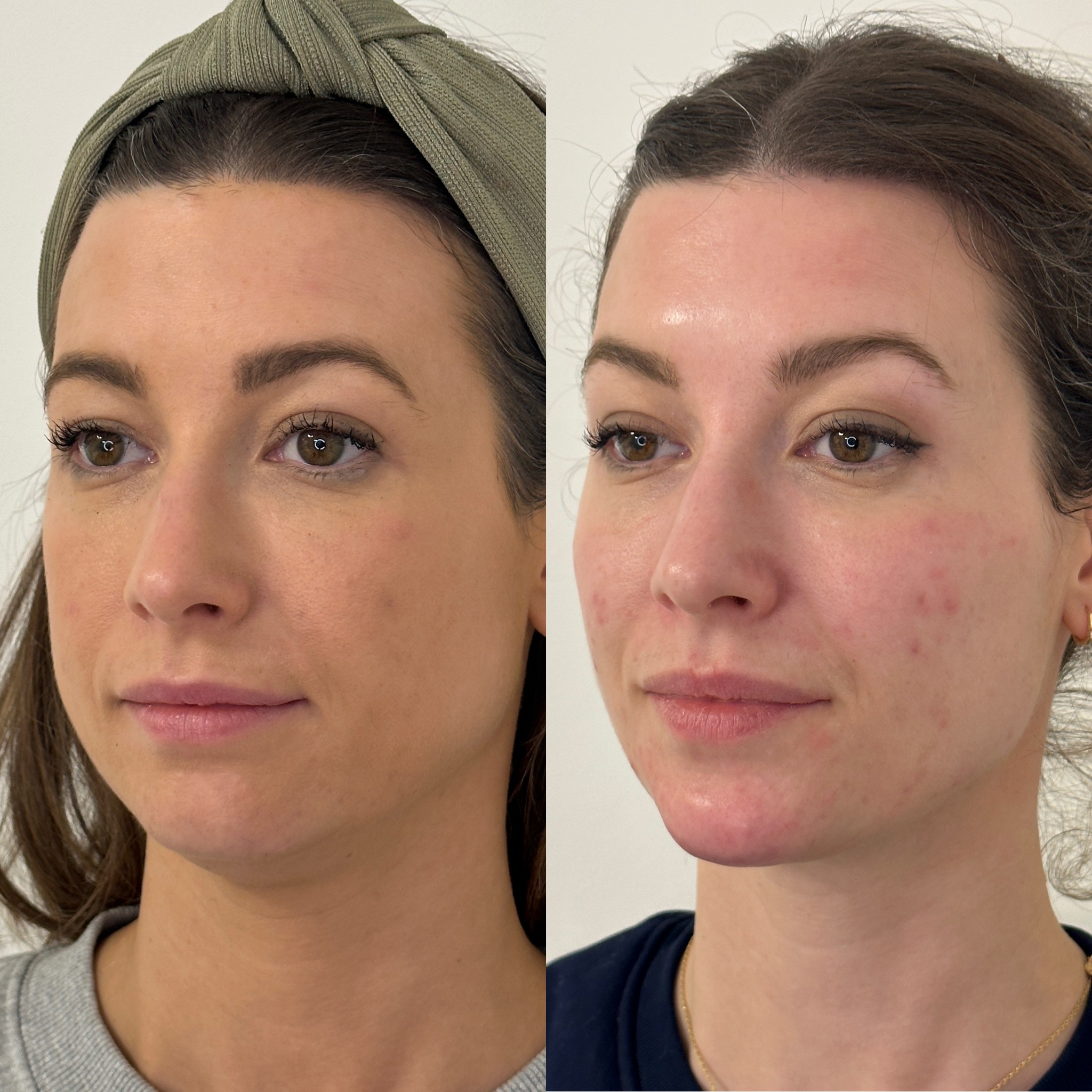 Facial Harmonisation 4