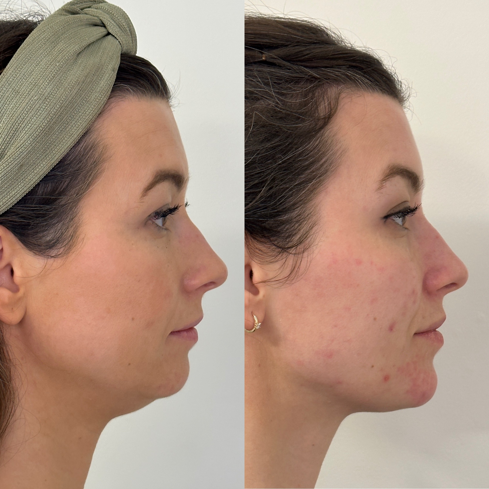 Facial Harmonisation 4