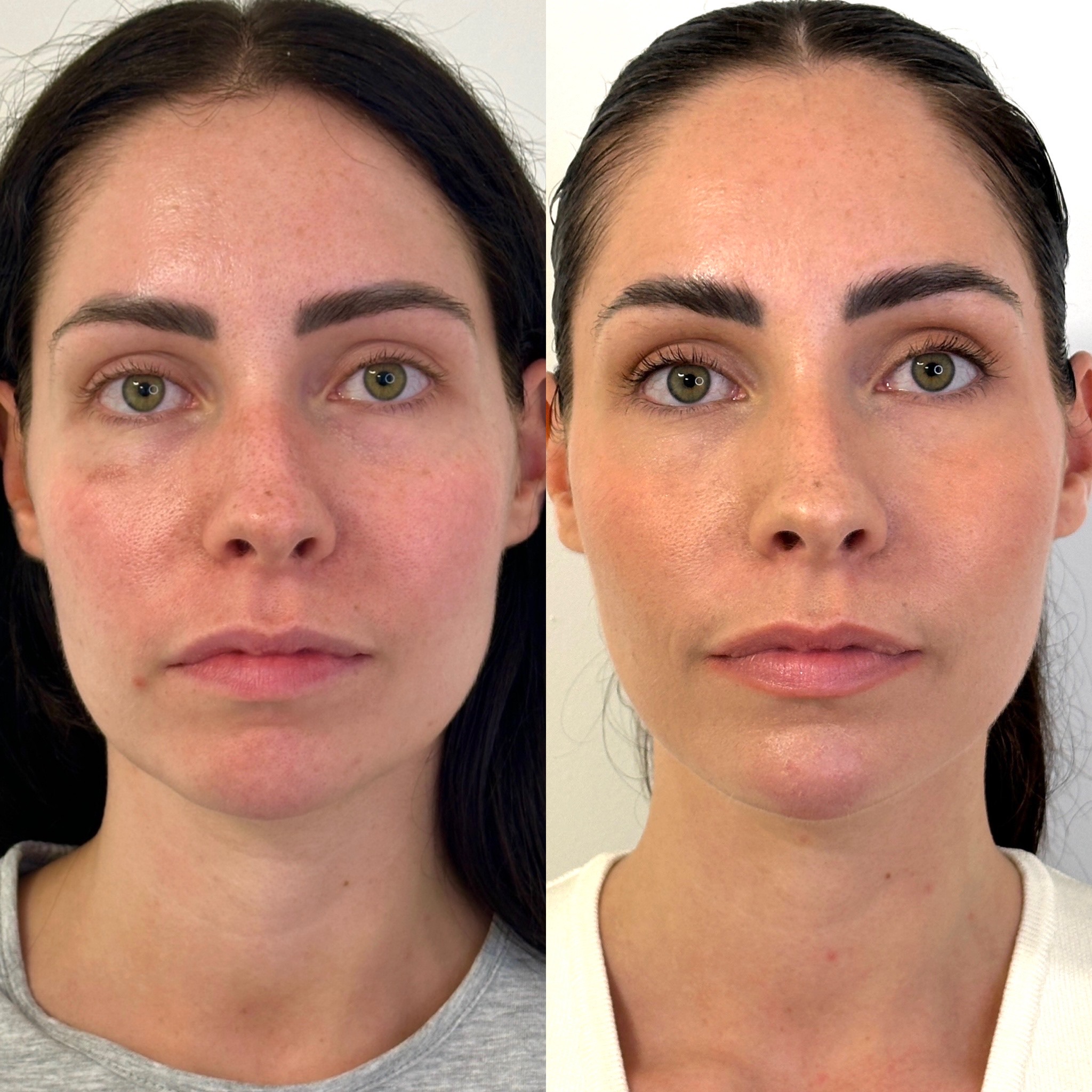 Facial Harmonisation 4