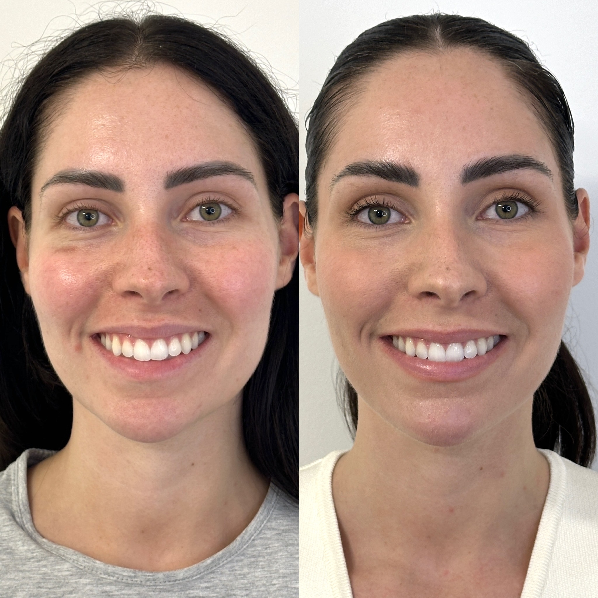 Facial Harmonisation 4