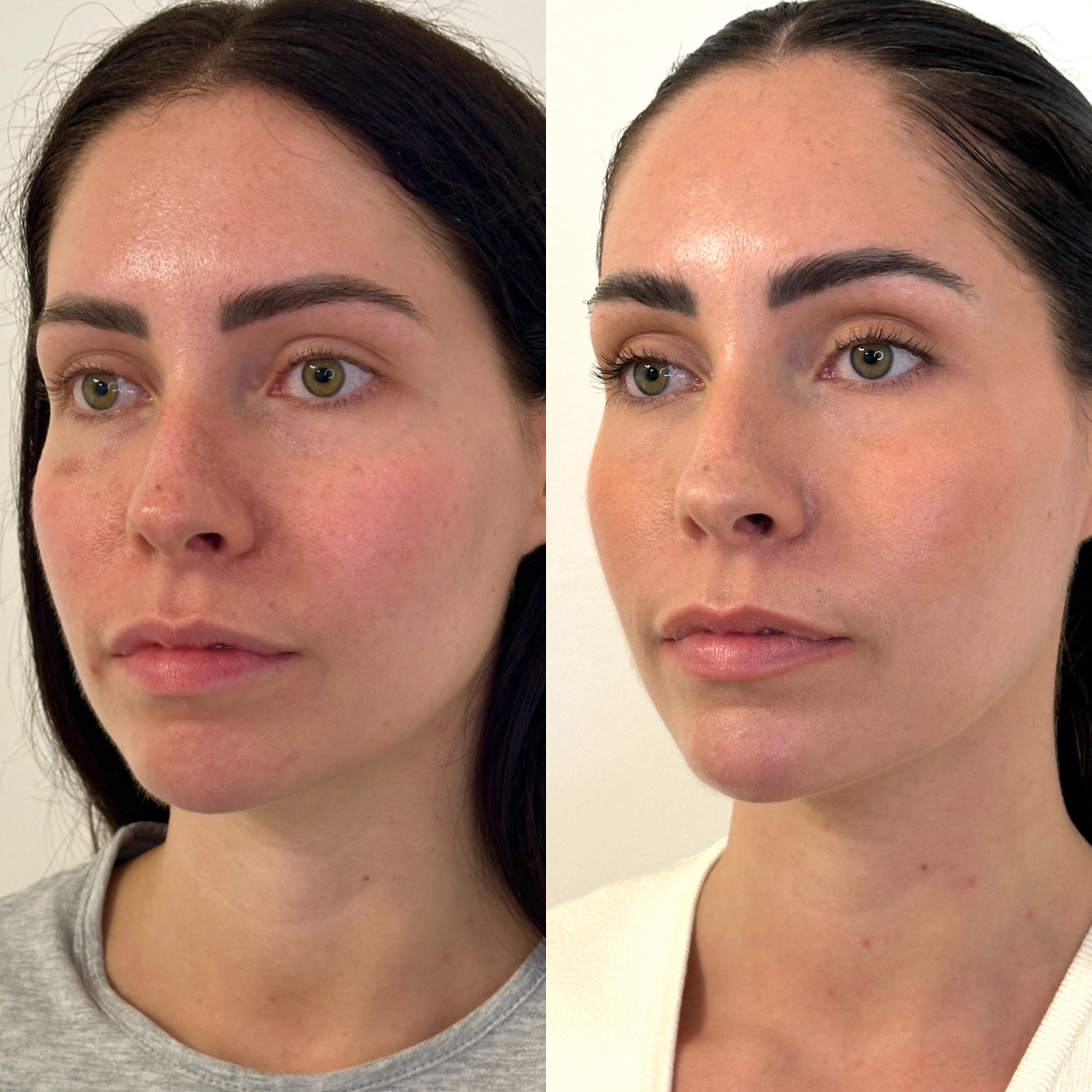 Facial Harmonisation 4