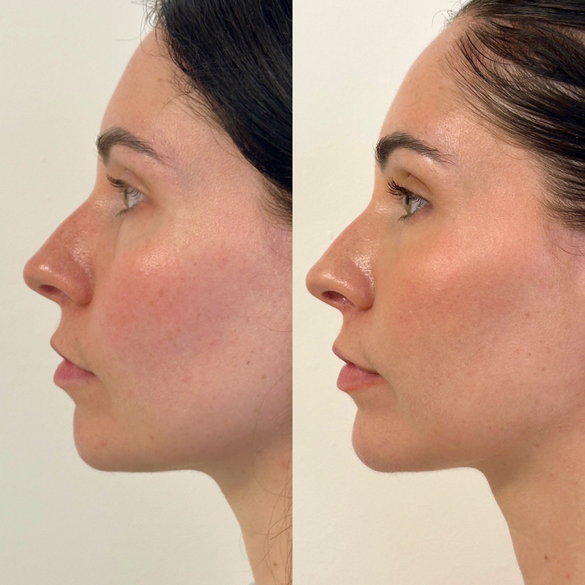 Facial Harmonisation 4